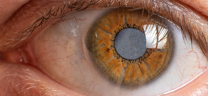Cataracts